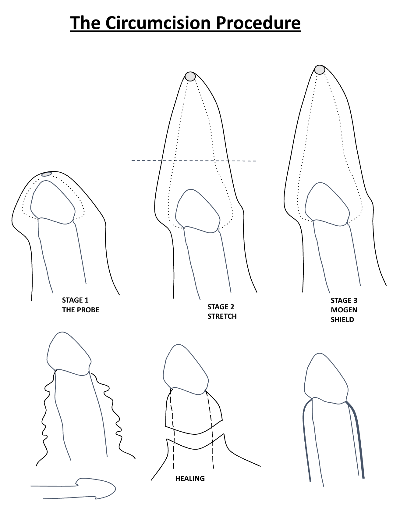 The Circumcision Procedure — Stage 1 The Probe, Stage 2 Stretch, Stage 3 Mogen Shield, and Healing